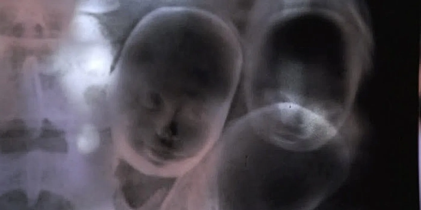 A sonogram of the swallowed Judy Doll heads in Grey's Anatomy